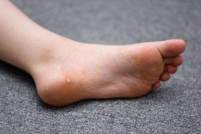 Plantar wart warts prevention runnerclick irritated diagnosis