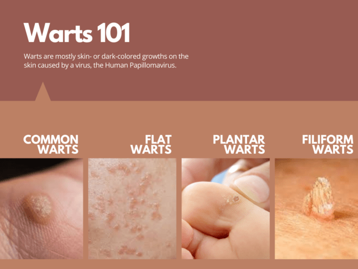 Plantar warts wart